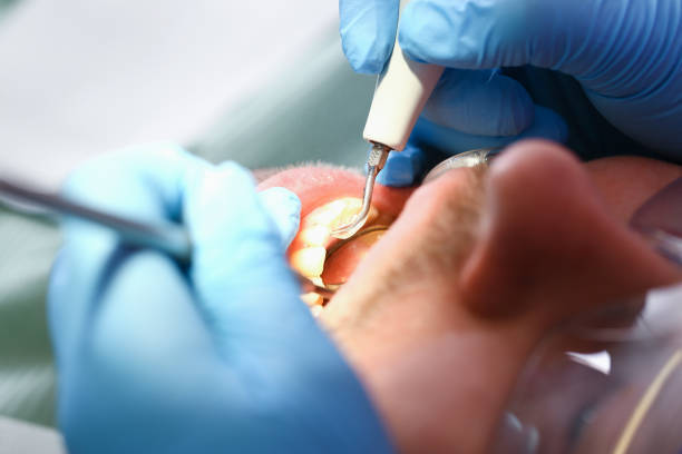 Best Emergency Root Canal Treatment in Ama, LA
